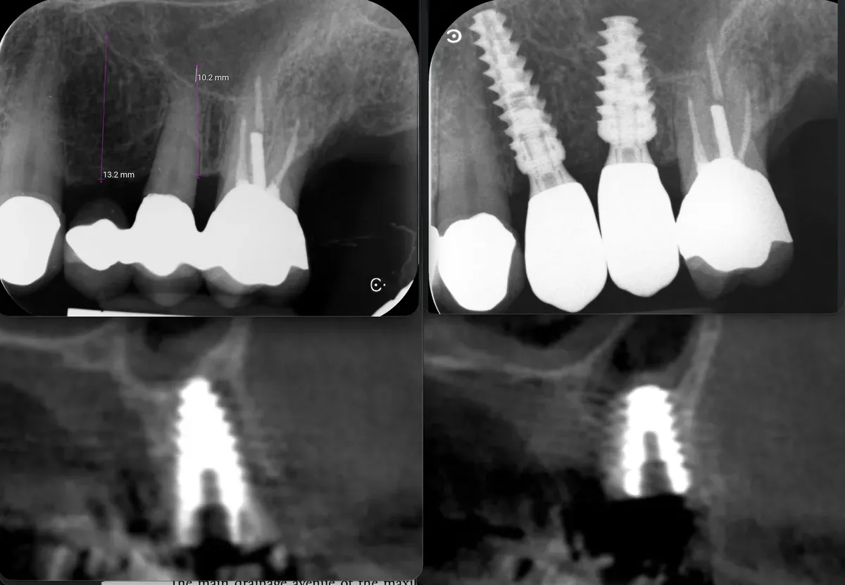 Stabilità di un altro pianeta: minirialzo e carico immediato