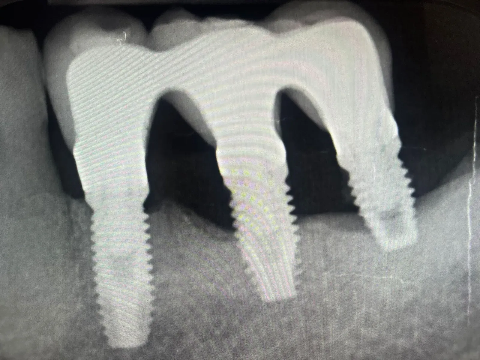 Controllo a 3 anni: riduzione dei difetti verticali e fill osseo periimplantare in progressione