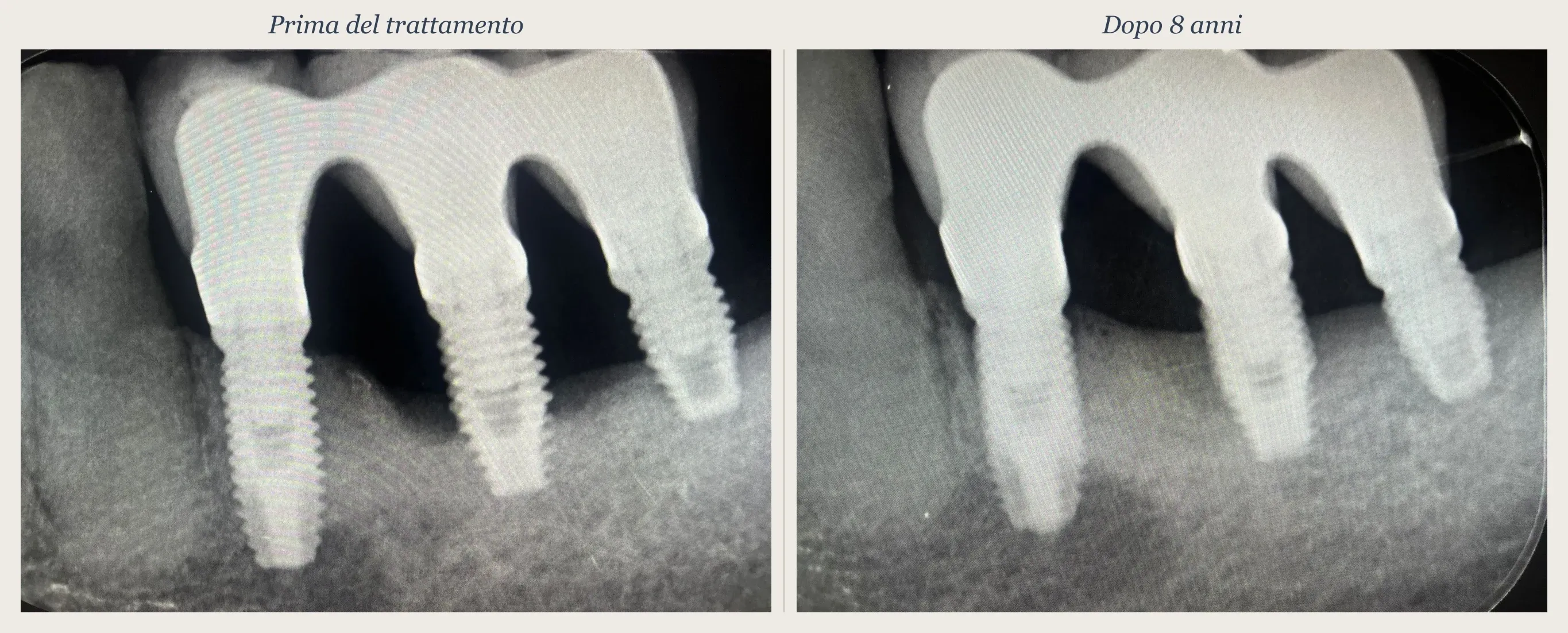 Confronto radiografico prima e dopo: peri-implantite trattata in modo non chirurgico con tecnica TST, follow-up a 8 anni con fill osseo periimplantare