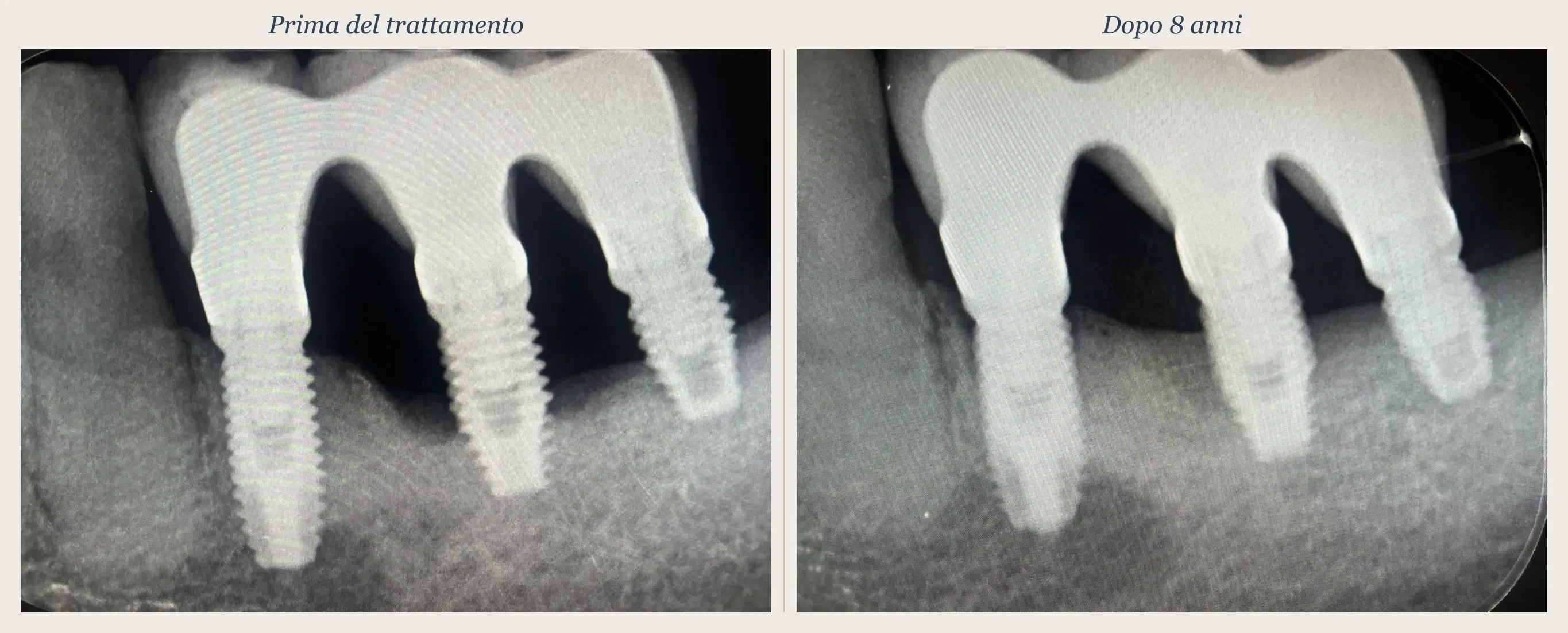 Confronto radiografico prima e dopo: peri-implantite trattata in modo non chirurgico con tecnica TST, follow-up a 8 anni con fill osseo periimplantare