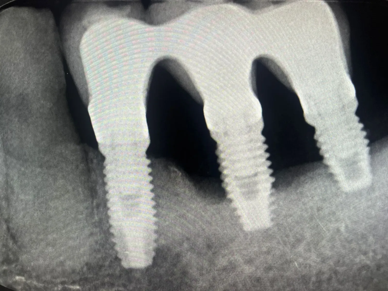 Situazione iniziale: difetti ossei verticali periimplantari sui tre impianti splintati, spire esposte