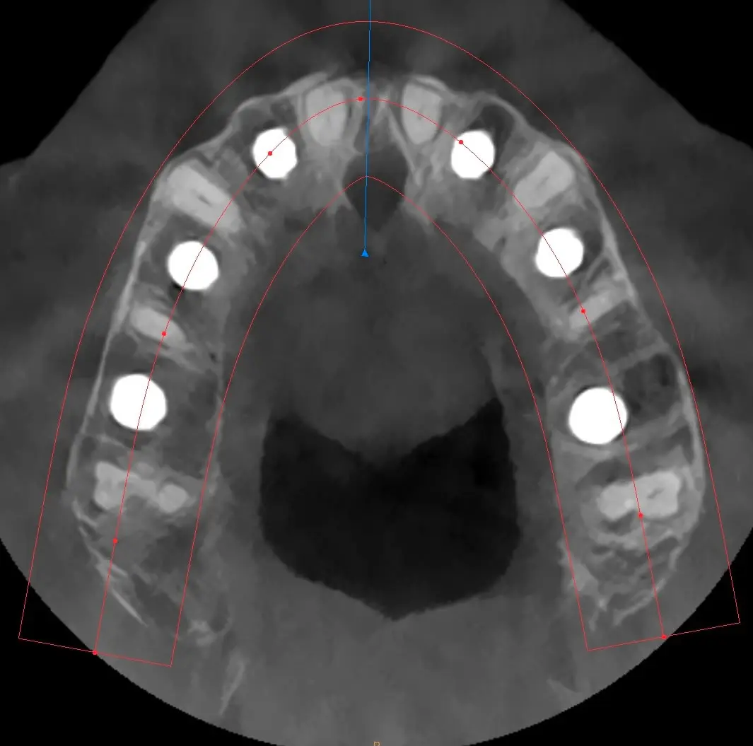 CBCT assiale: sei impianti mascellari posizionati con tecnica Bonebenders