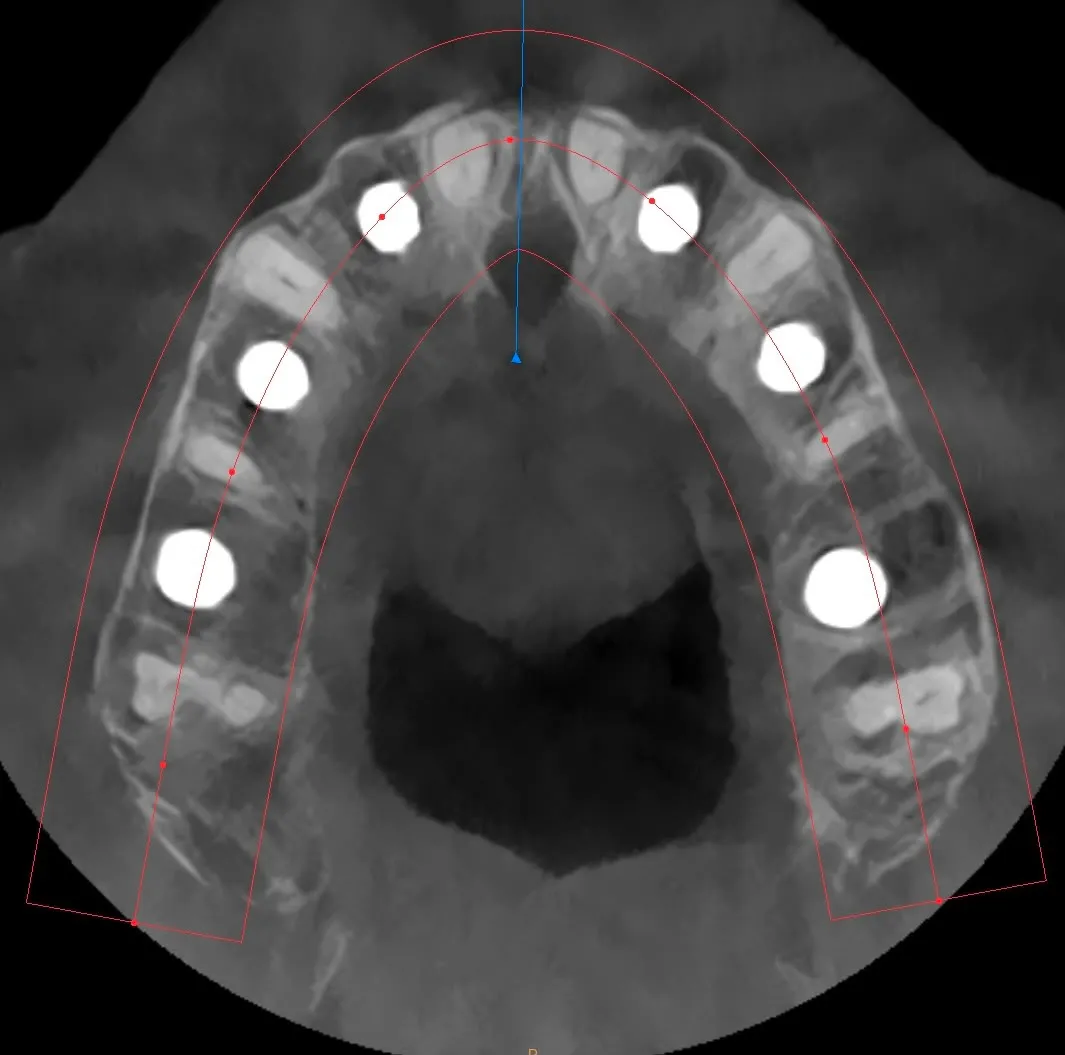 CBCT assiale: sei impianti posizionati nelle posizioni 1.6–1.4–1.2–2.2–2.4–2.6