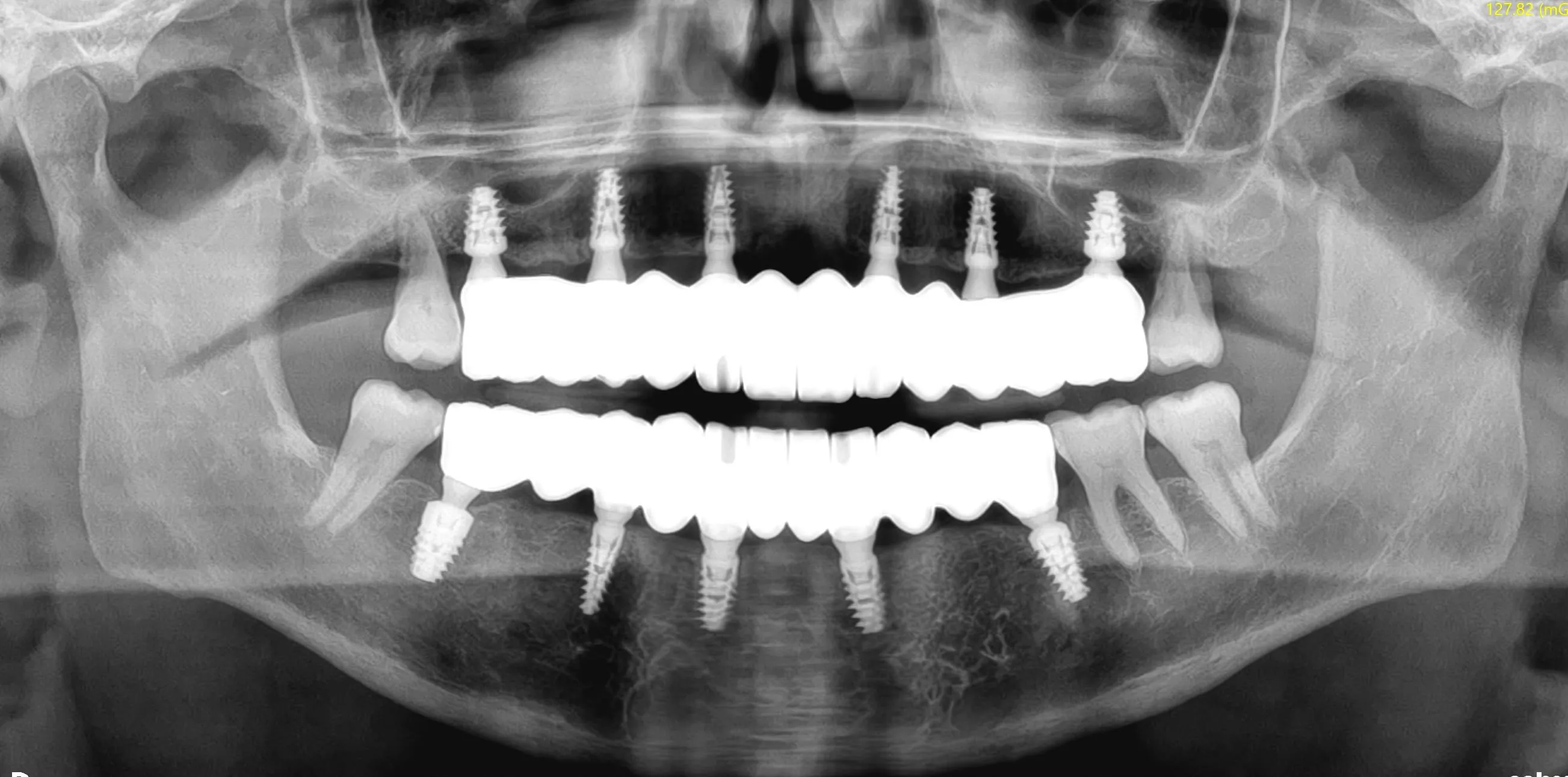 Ortopantomografia finale: riabilitazione implantoprotesica completa bimascellare