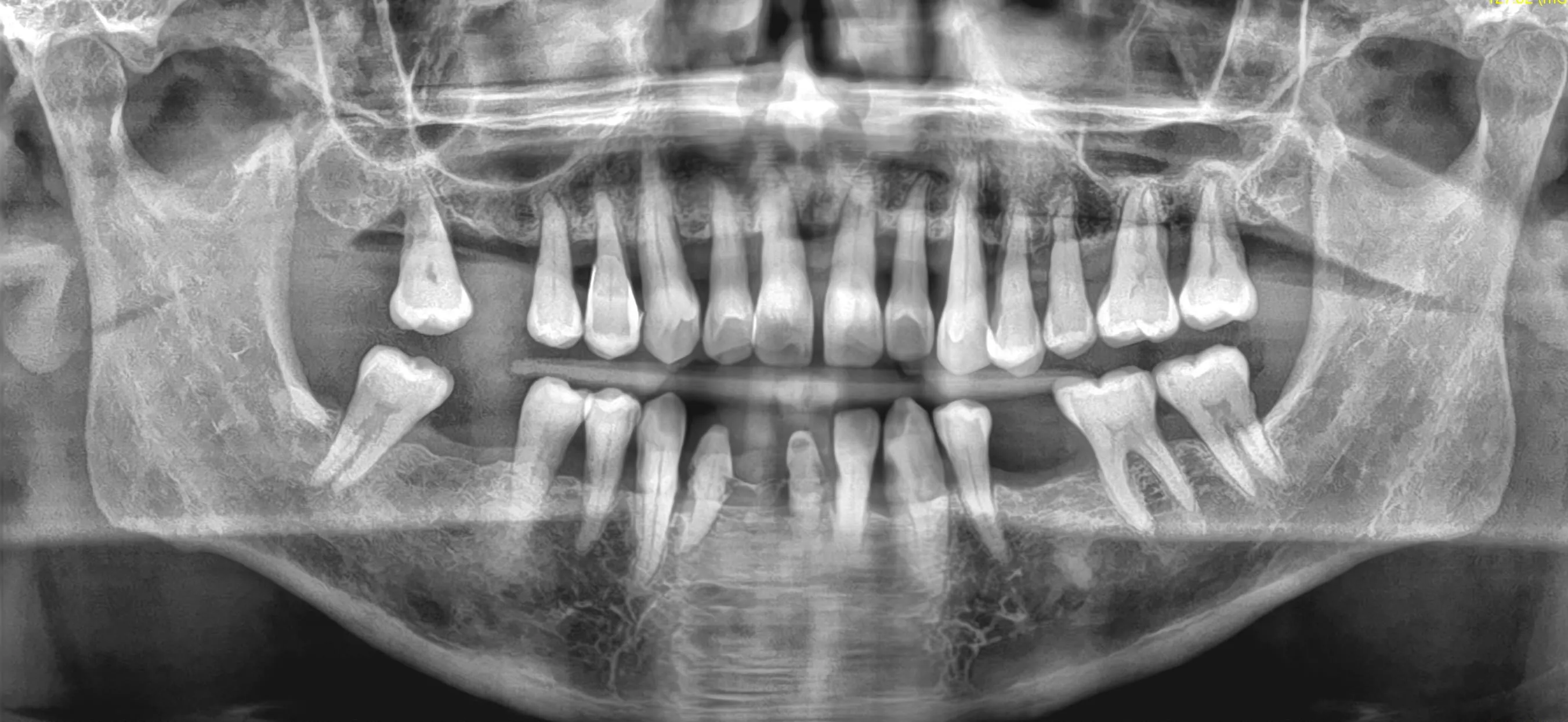 Ortopantomografia pre-operatoria: parodontite avanzata con perdita ossea generalizzata