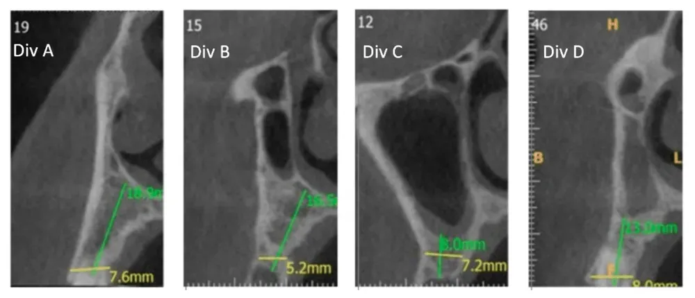 
Da sinistra a destra—Sezioni trasversali CBCT: Divisione A (Div. A): Cavità nasale da sola; Divisione B (Div. B): Cavità nasale adiacente alla cavità sinusale; Divisione C (Div. C): Cavità sinusale da sola sopra la cresta alveolare; Divisione D (Div. D): La cavità nasale è posizionata in posizione superiore rispetto alla cavità sinusale. Da Yahya et al. (2021). Licenza CC4.0.