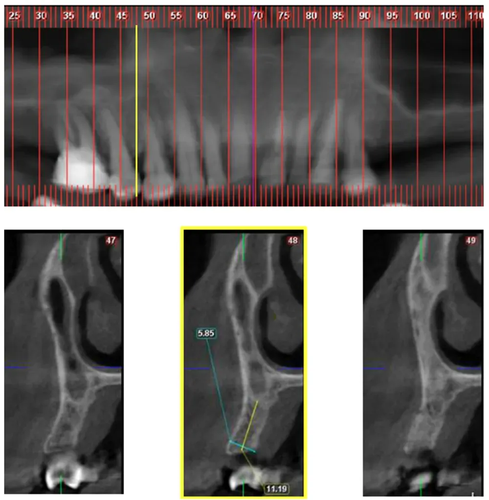Classe 2 della variante big nose del seno mascellare