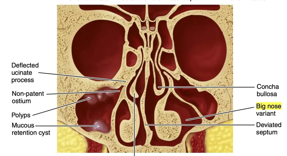 Figura della variante big nose tratta da  Misch, Contemporary Implant Dentistry