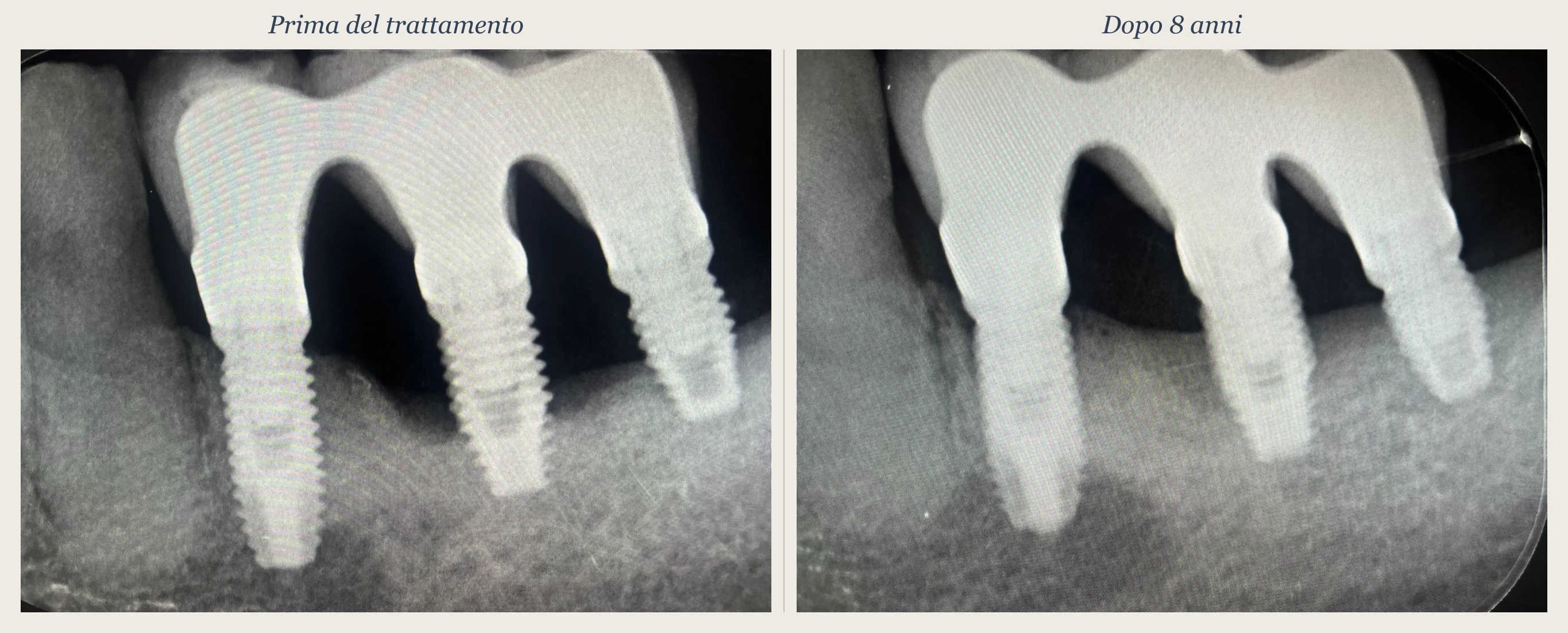 Confronto radiografico prima del trattamento e a 8 anni: fill osseo dei difetti verticali periimplantari ottenuto con la sola terapia non chirurgica TST